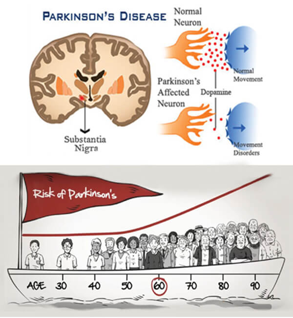 causes of parkinsons